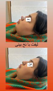 لیزر موهای زائد اردبیل