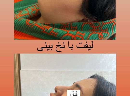 اصلاح فرم بینی بدون جراحی در اردبیل دکتر غلامرضا هادی