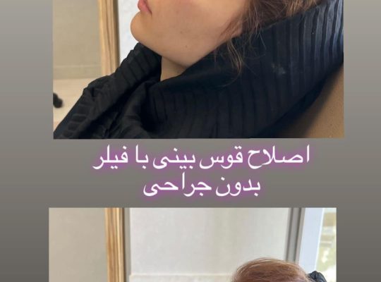 اصلاح فرم بینی بدون جراحی در اردبیل دکتر غلامرضا هادی