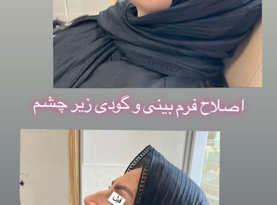 اصلاح فرم بینی بدون جراحی در اردبیل دکتر غلامرضا هادی