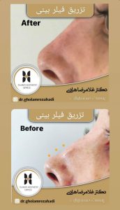 اصلاح فرم بینی