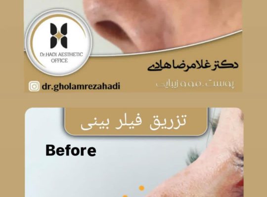 اصلاح فرم بینی بدون جراحی در اردبیل دکتر غلامرضا هادی