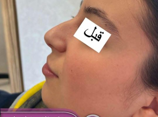 اصلاح فرم بینی بدون جراحی در اردبیل دکتر غلامرضا هادی