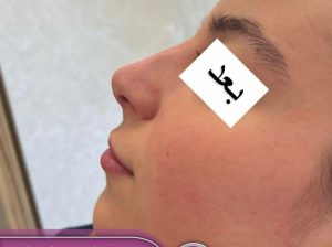 اصلاح فرم بینی بدون جراحی در اردبیل دکتر غلامرضا هادی