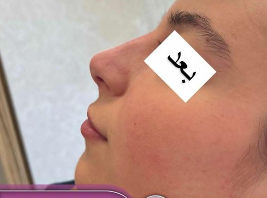 اصلاح فرم بینی بدون جراحی در اردبیل دکتر غلامرضا هادی