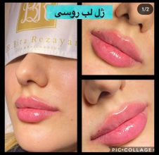 تزریق بوتاکس گرگان دکتر بیتا رضایانی