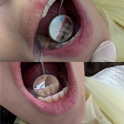 مطب دندانپزشکی شیرین رشت | ترمیمی، عصب‌کشی، زیبایی و پروتز دندان